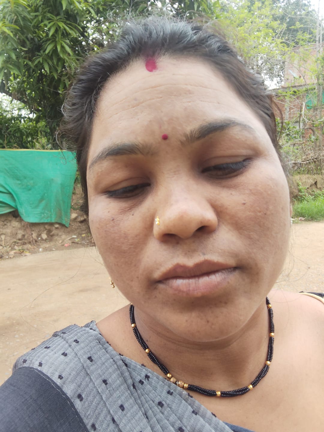 Real VaidicHerb customer — melasma 2