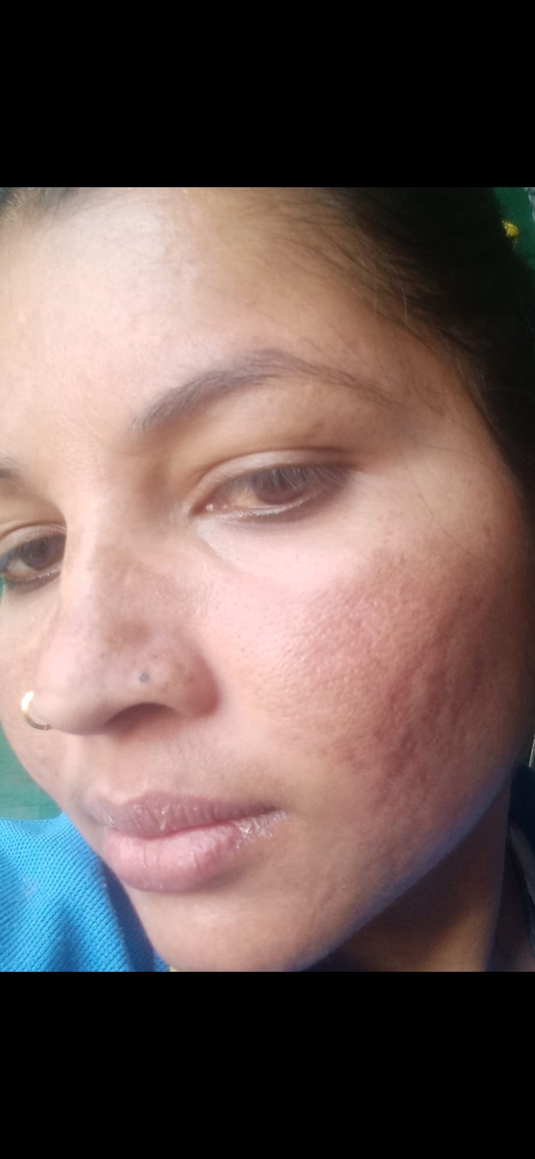 Real VaidicHerb customer showing facial redness concern