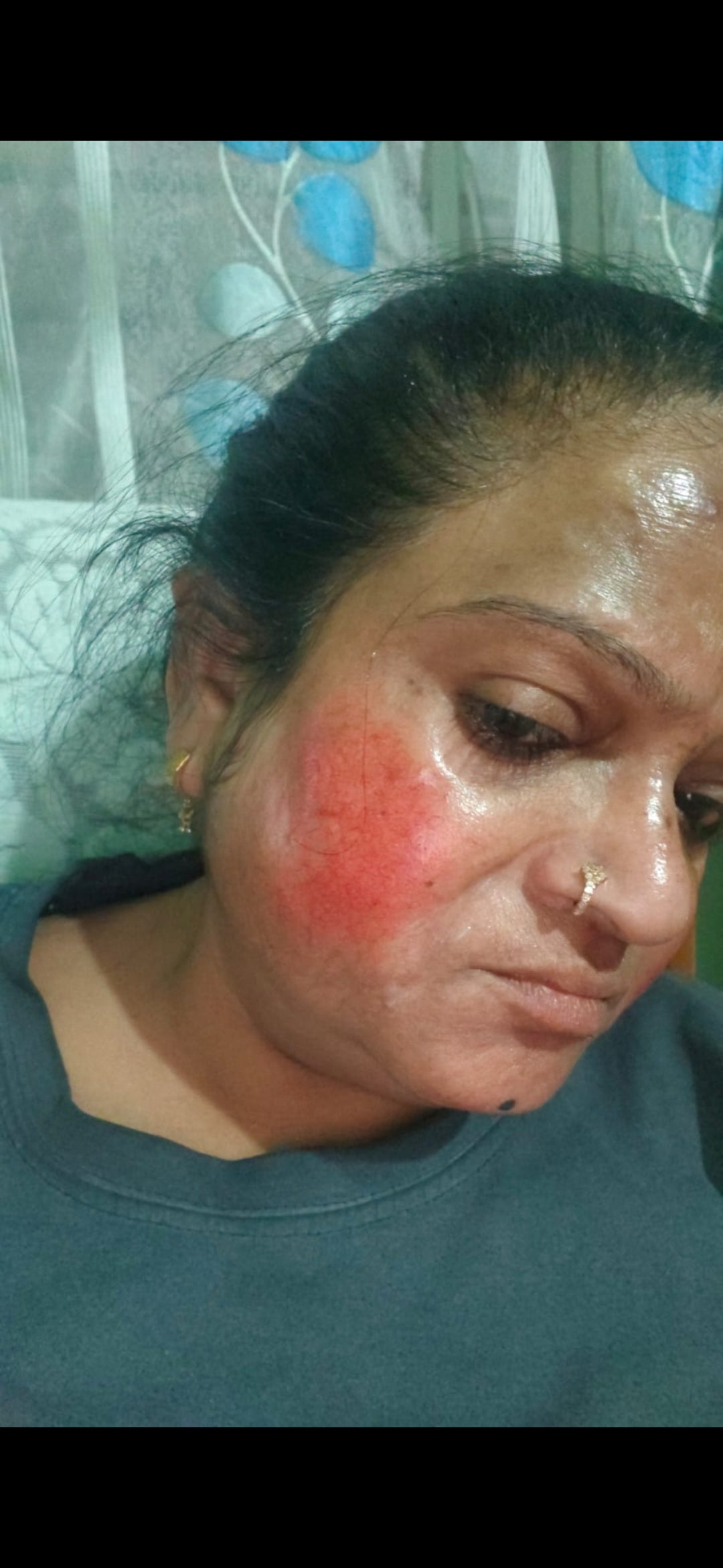 Real VaidicHerb customer showing redness concern